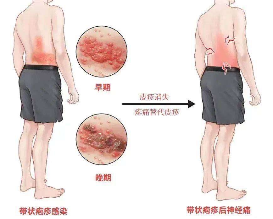 一旦感染终身携带<strong></p>
<p>屋里币</strong>！深圳疾控提醒：这4类人要注意