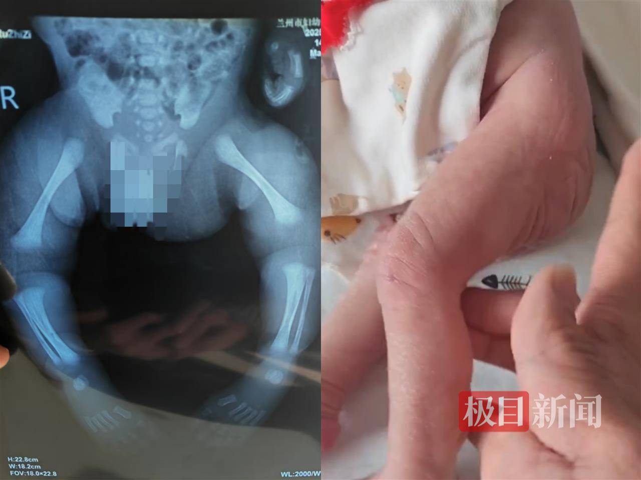 二胎出生查出先天性病症或落下残疾<strong></p>
<p>牛币商城</strong>，残疾父母称医院产检漏检、未尽告知义务，医院及医调委回应