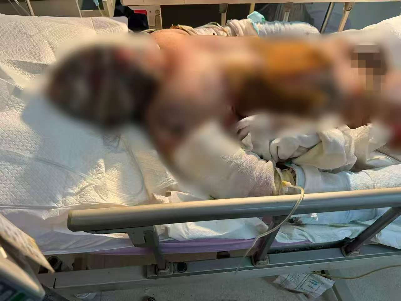 父子在哈尔滨一亲戚公司上班遇爆炸全身烧伤<strong></p>
<p>火特币</strong>,治疗花费近百万公司拒赔偿?亲戚回应