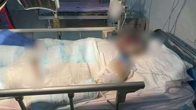 父子在哈尔滨一亲戚公司上班遇爆炸全身烧伤<strong></p>
<p>火特币</strong>,治疗花费近百万公司拒赔偿?亲戚回应