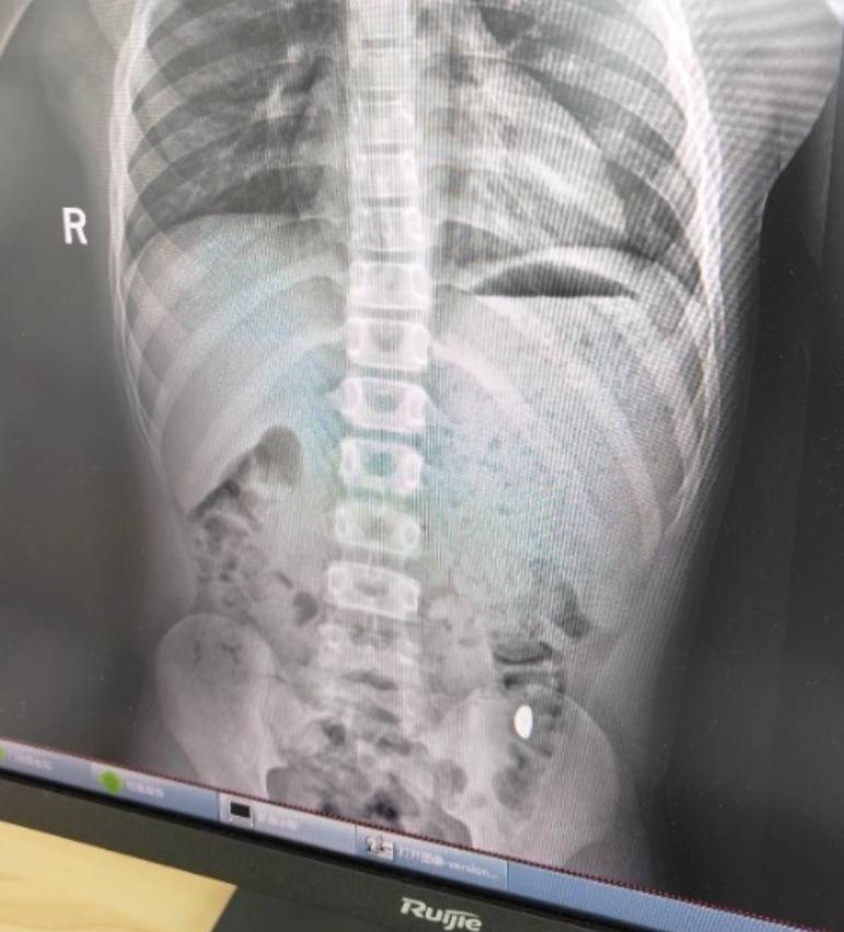 “熊孩子”误吞10克重金豆<strong></p>
<p>云币海外</strong>，妈妈：天天叮嘱他不要在外面拉屎